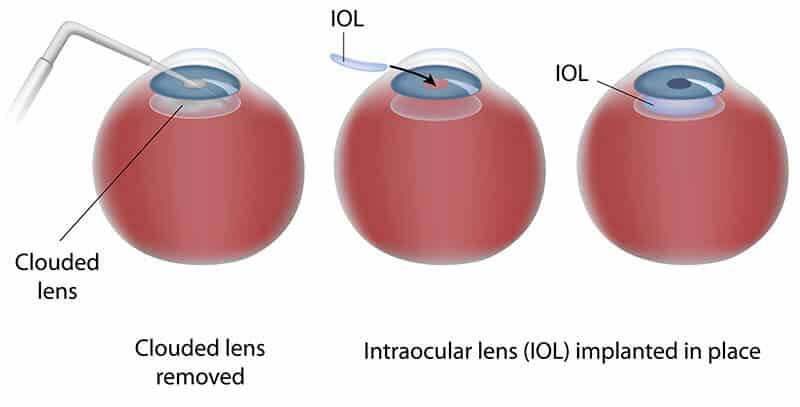 Chart Illustrating the Cataract Surgery Process