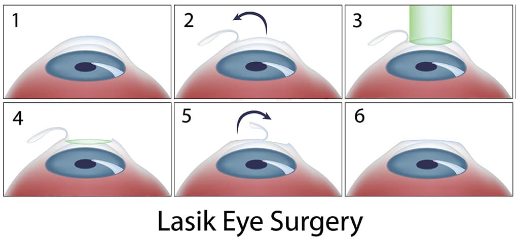 Chart Illustrating the LASIK Surgery Process