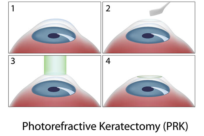 Illustration of the PRK Surgery Process